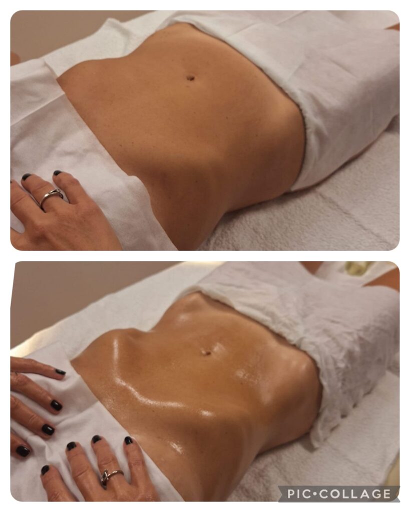 neinvazivni tretmani za mršavljenje