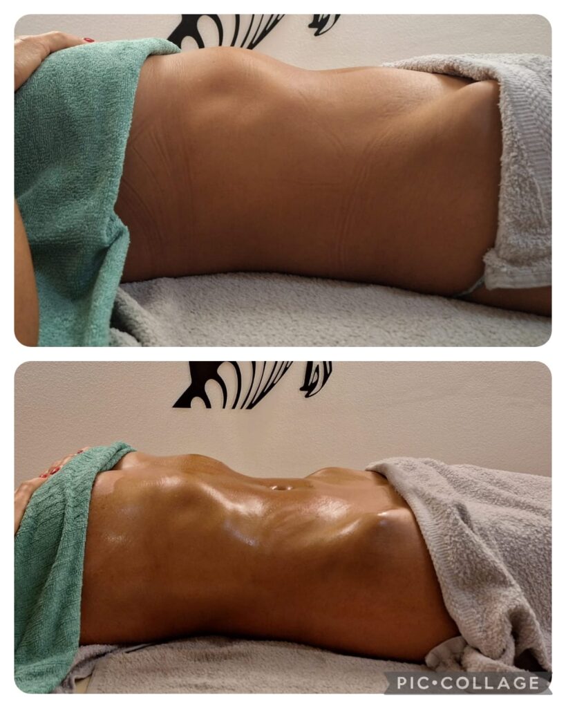 neinvazivni tretmani za mršavljenje